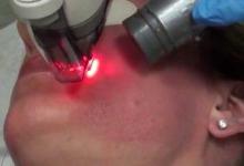 Уход за кожей после лазерной шлифовки: нюансы реабилитации